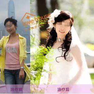 先天性无阴道女孩手术成功,穿上婚纱做新娘